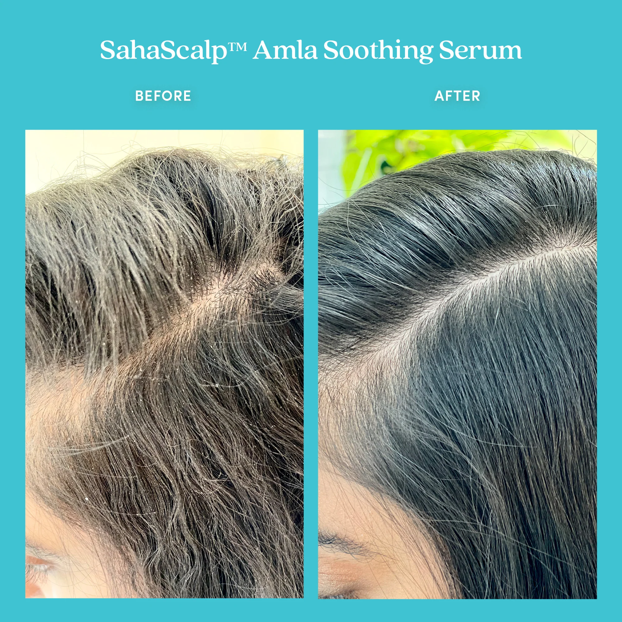 SahaScalp™ Amla Soothing Serum - Image 5